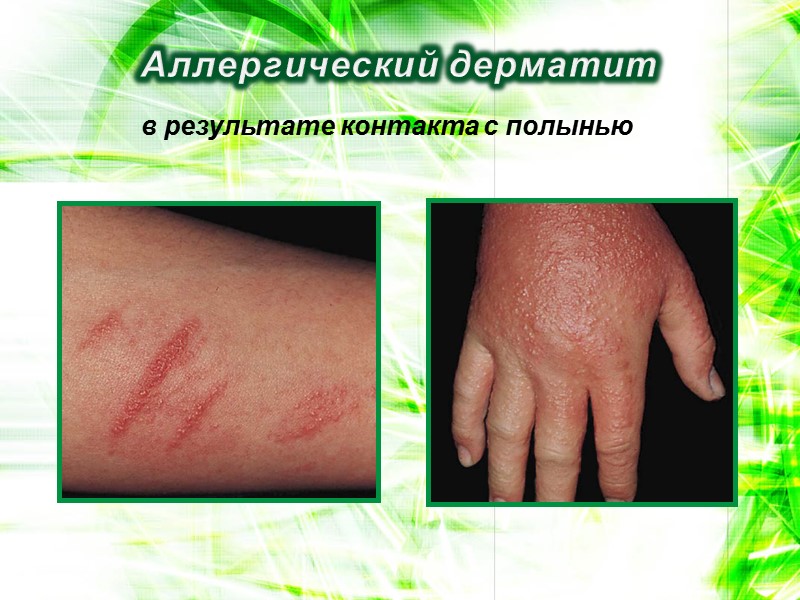 Аллергический дерматит в результате контакта с полынью